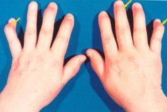 手指风湿性关节炎有哪些症状