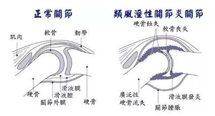 成都西部痛风风湿医院