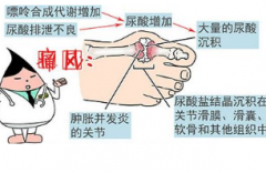 痛风尿酸升高了怎么办？降尿