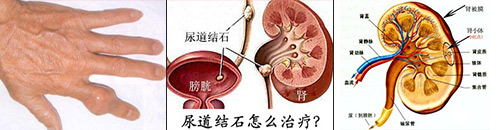 成都西部痛风风湿医院